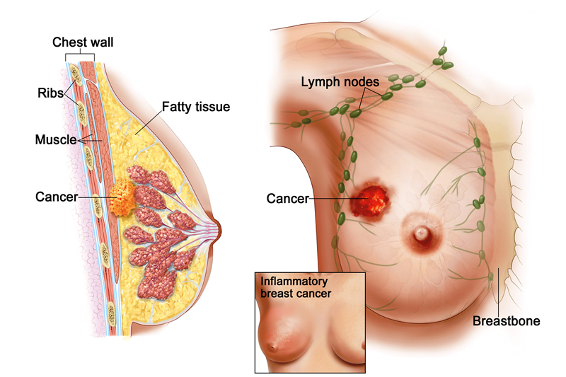Điều trị ung thư vú